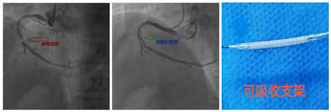 【患者福音】心脏支架可自行吸收!番禺区中