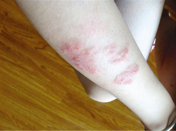 院的皮肤科门诊了解到,每年高温时期,都有不少因虫咬前来就诊的患者