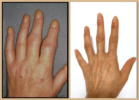 风湿免疫17岁少女关节疼痛肿胀原来是红斑狼疮作怪